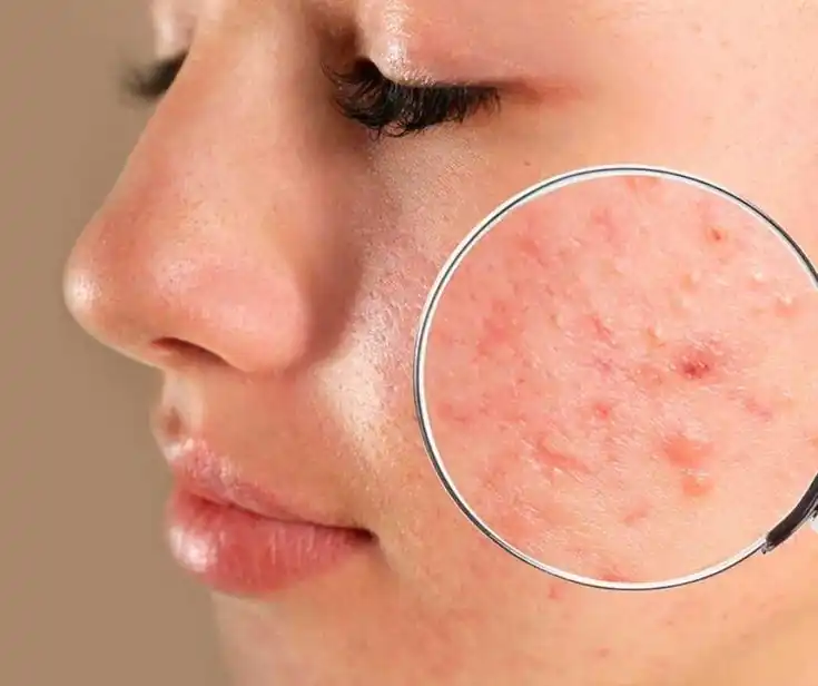 Acne Treatment Rejuve